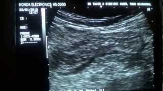 DIVERTICULITIS sigmoidocolonic [upl. by Nalro]