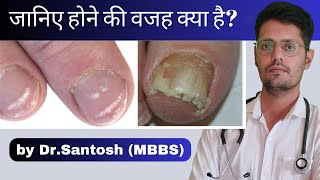 Causes of white spots in finger amp toe nails in hindi Leukonychia causes causes of abnormal nails [upl. by Allimaj]