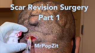 Scar revision surgery part 1 Removal of fibrous scar tissue from chronic Pilar cyst patient [upl. by Eamon]