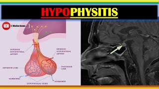 HYPOPHYSITIS  SYMPTOMS OF HYPOPHYSITIS  CAUSES OF HYPOPHYSITIS  HYPOPHYSITIS NOTES  MEDSURG [upl. by Costello]