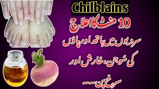 Itchy Toes And Fingers  Chilblains Treatment At Home  How To Treat Swollen Hands In Winters [upl. by Lauzon471]