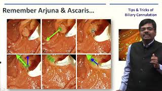 ERCP Masterclass  Tips And Tricks of Selective Biliary Cannulation [upl. by Deborah]