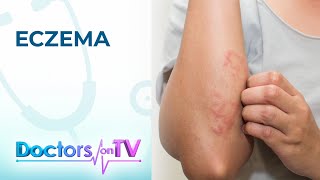 Eczema Symptoms Causes and Treatment  Doctors on TV [upl. by Nacul]