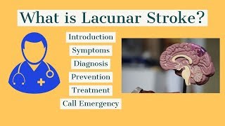 How to treat lacunar Stroke [upl. by Esina369]