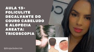 Aula 13 Foliculite Decalvante e Alopecia Areata [upl. by Safko]