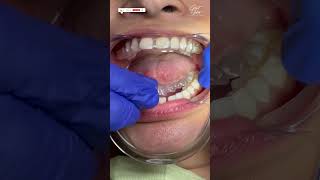 Invisalign Braces  Aligners for Teeth  Invisalign Time Lapse  invisalign invisalignsmile short [upl. by Dempsey106]