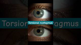 torsional nystagmus👀optoversedubai4066 optometrywithsamir optometrysolutionsoptometrists [upl. by Haff]