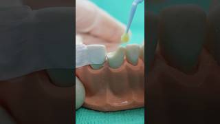 Resina dental con guía de silicona [upl. by Ah856]