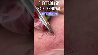 Electrolysis Hair Removal [upl. by Oicanata]