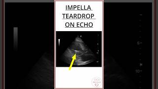 IMPELLA TEARDROP ON ECHOCARDIOGRAM A METALLIC CONE 7mm impellla [upl. by Carce]