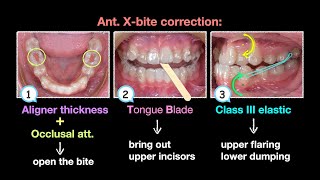 Anterior crossbite clinical tip aligner｜【Chris Chang Ortho】CC753 [upl. by Killigrew33]