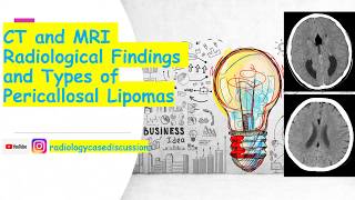 32  CT and MRI Radiological Findings and Types of Pericallosal Lipomas [upl. by Autrey]