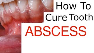 Tooth Abscess Explained [upl. by Wilbert588]