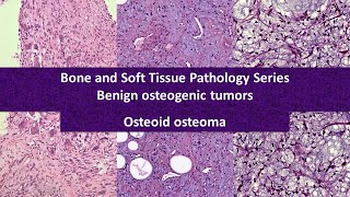 Osteoid osteoma 101  highyield educational video [upl. by Faires]