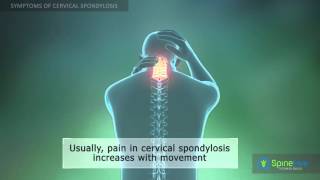 Cervical Spondylosis Symptoms [upl. by Mloclam123]