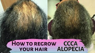 How to regrow your hair  CCCA Alopecia Central Centrifugal Cicatricial Alopecia hair care [upl. by Pollitt203]