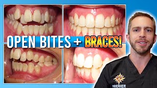 Open Bite Braces Treatment BEFORE amp AFTER [upl. by Yenot]