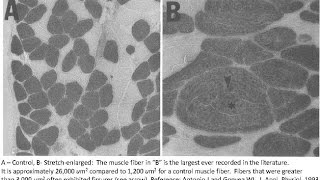 Muscle Hyperplasia in Humans [upl. by Alexandros]