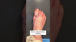 Elder Patients Fixed Bunion amp Hammertoe 😮 [upl. by Secnirp]