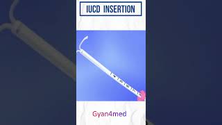 IUD insertion procedure in Hindi [upl. by Nnylyt]