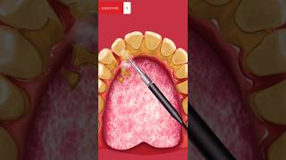 cleaning of tartar asmr cleaningteeth animation mouthcleaning asmranimation [upl. by Kemme]