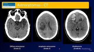 Emergency Imaging of Brain Tumors Astrocytomas [upl. by Nosirb]