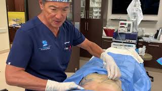 Microcannula Tumescent Liposuction Procedure [upl. by Henriha]