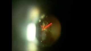 Amazing Eye Floater Membrane Treatment with Laser [upl. by Arahsal]