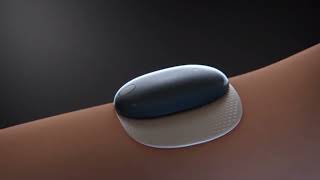 90day Senseonics Eversense Continuous Glucose Monitor Promotional Video [upl. by Nido465]