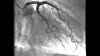 Kardiologie linkes Herzkranzgefäß  Darstellung der Kornararterien [upl. by Tymon]