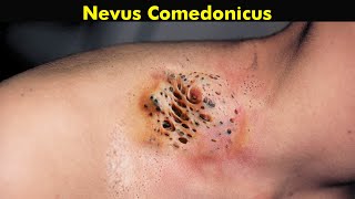 Nevus Comedonicus  A Rare Skin Disease UrduHindi [upl. by Zea]