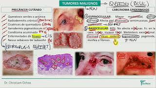 Dermatología  Tumores malignos [upl. by Colwell149]