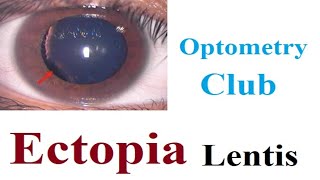 Ectopia Lentis Lens Subluxation [upl. by Citron122]