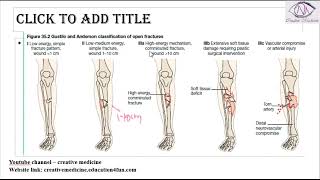 Lec 8 Gustillo Anderson classification of open fractures mp4  ORTHOPEDICS [upl. by Kcyrred525]