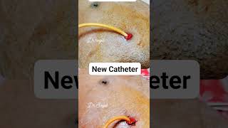 Suprapubic Catheter Replacement spc viralvideo viral satisfying watch foryou love trending [upl. by Releyks288]