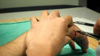 6 pinskwires removed from healed hand [upl. by Ardeed207]