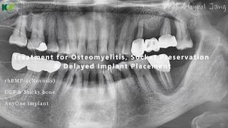 Ridge preservation using rhBMP2 in large alveolar bone defect [upl. by Laohcin977]