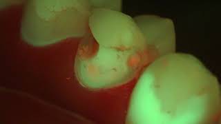 Real time Caries Diagnosis using Zeiss Extaro 300 in Fluorescence Mode [upl. by Retniw]