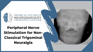 Peripheral Nerve Stimulation for NonClassical Trigeminal Neuralgia [upl. by Tsenrae]