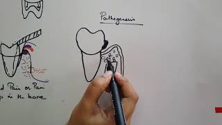 Periodontal Pocket Part 1 [upl. by Ytsenoh]