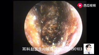 The cholesteatoma of the external auditory canal was cleared by otoendoscopy No deletion 14 minute [upl. by Nalniuq]