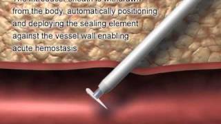 FastSeal® Bioabsorbable Vascular Access Closure Systemwmv [upl. by Neersan]