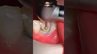 Class V caries dentist dentista teeth tooth fyp satisfying dentaldisease dentistteeth [upl. by Darci]