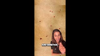 What is Cherry Angiomas [upl. by Luttrell349]