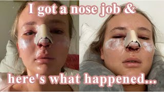 WHAT IT’S REALLY LIKE DAYS 17  MY SEPTOPLASTY amp RHINOPLASTY JOURNEY  Pt 1 [upl. by Etnaed997]