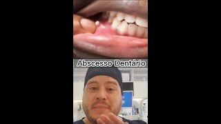 ESPINHA GIGANTE na Gengiva 🤔  Abscesso Dentário shorts [upl. by Mart]