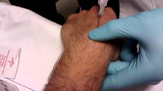 Ganglion cyst Aspirationremoval done right [upl. by Nonah]