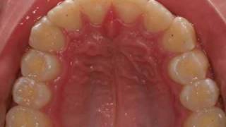 invisalign severe overjet [upl. by Ludba244]