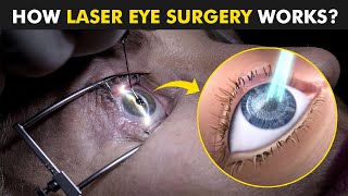 How Laser Eye Surgery Lasik is Performed  Lasik plus Miami [upl. by Iraj]