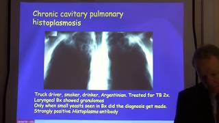 Diagnosis and treatment of chronic pulmonary aspergillosis [upl. by Dirgni]